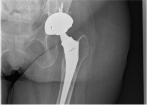 hip replacement surgery after xr hh showing xray implant position total