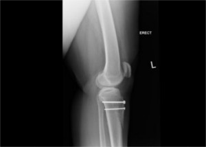 XRay image of knee after knee cap surgery for patellar realignment - Front view.