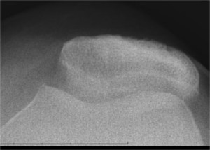 XRay image of knee before surgery, showing patello-femoral (knee cap joint) arthritis with associated patella maltracking ( misalignment).