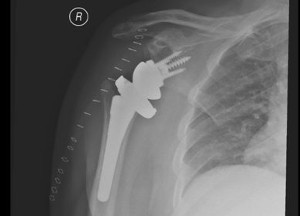 XRay image of shoulder after Reverse Total Shoulder Replacement with implant in place.